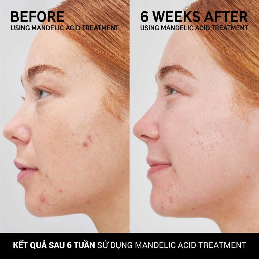 Serum giúp giảm thâm dành cho da mụn The Inkey List | Mandelic Acid Treament-duoc-ban-tai-Offload Spa