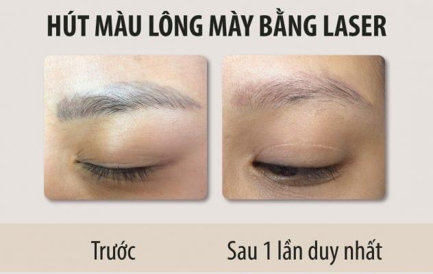 Xoá săm lông mày-duoc-ban-tai-TRANG QUỲNH BEAUTY & SPA