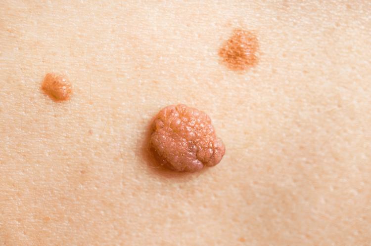 Mụn thịt cấp độ 1-duoc-ban-tai-Ngọc Thảo Beauty & Spa