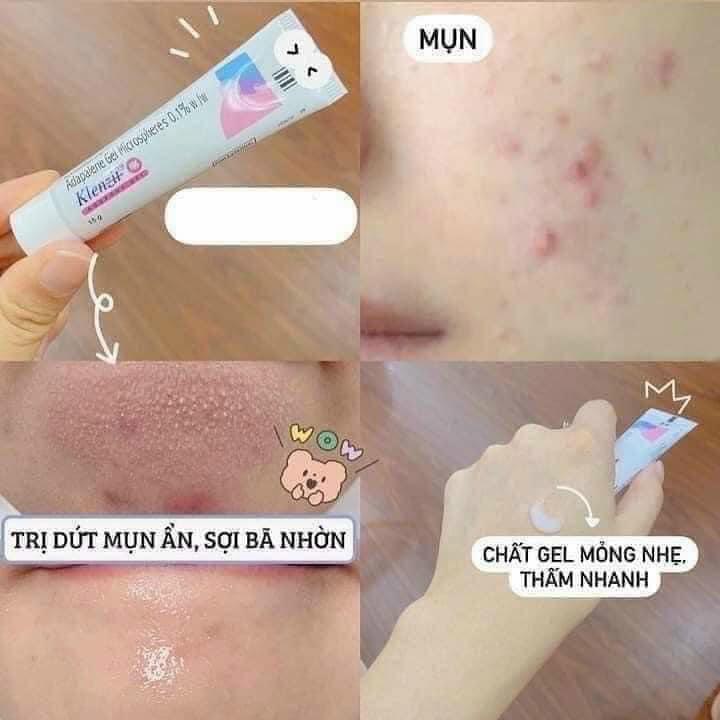 Gel Mụn Klenzit MS-duoc-ban-tai-𝑮𝒂̣𝒐 𝑪𝒐𝒔𝒎𝒆𝒔𝒕𝒊𝒄𝒔