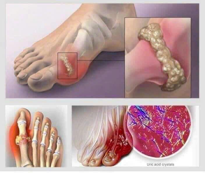 Viên Uống Gout Clear Tart Cherry The Natural Solution 60 viên Cho Người Bị Gout lâu năm.-duoc-ban-tai-Cửa Tiệm Nhỏ