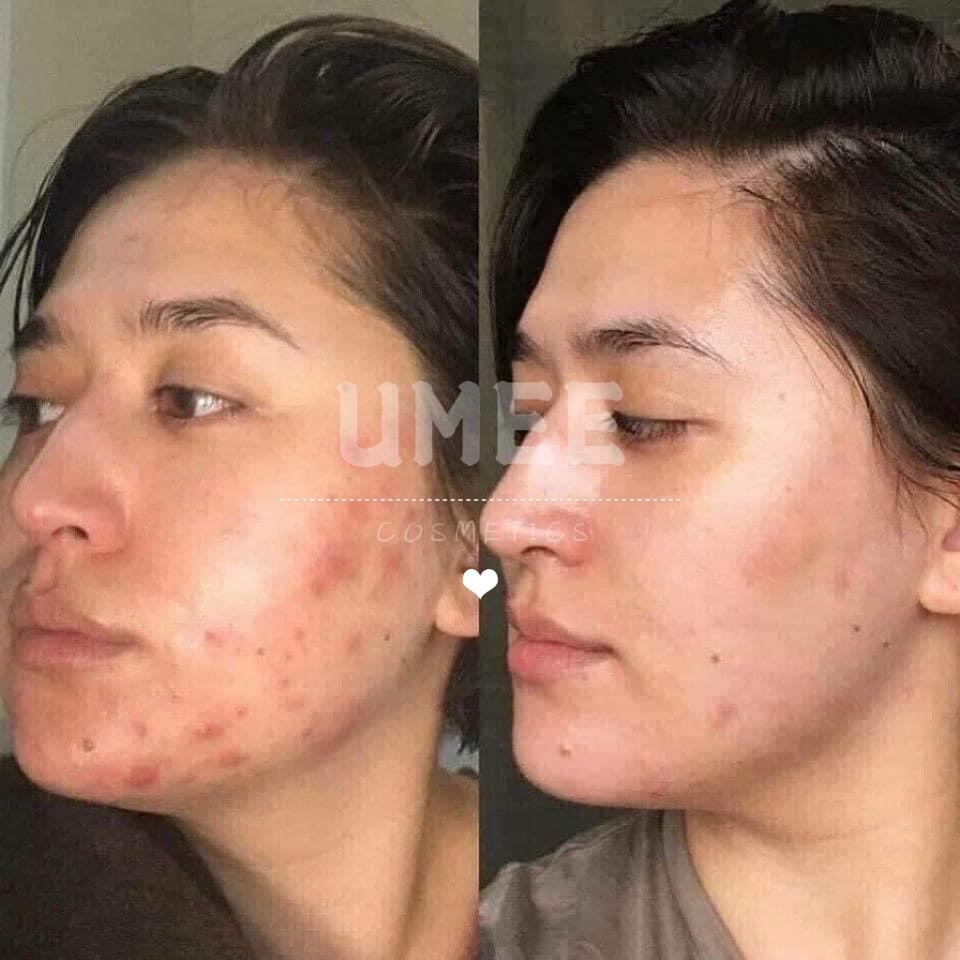 KEM GIẢM MỤN, MỜ THÂM SVR ACTIVE GEL SEBIACLEAR 40ML-duoc-ban-tai-UMEE COSMETICS - MAHHA CLOSET