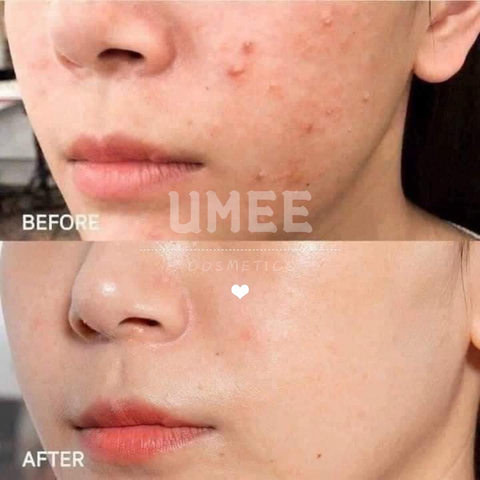 KEM GIẢM MỤN, MỜ THÂM SVR ACTIVE GEL SEBIACLEAR 40ML-duoc-ban-tai-UMEE COSMETICS - MAHHA CLOSET