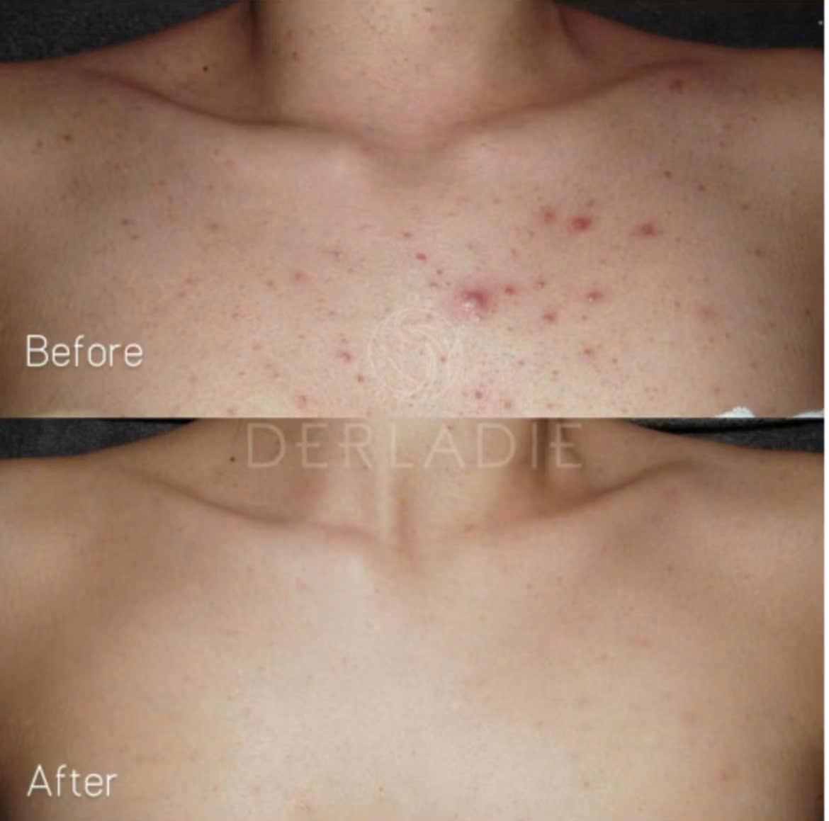 Xà Phòng Tắm Giảm Mụn Derladie Cleansing Bar For Blemish Skin Cho Body Cơ Thể 50g-duoc-ban-tai-Tiệm Nhà Mịn