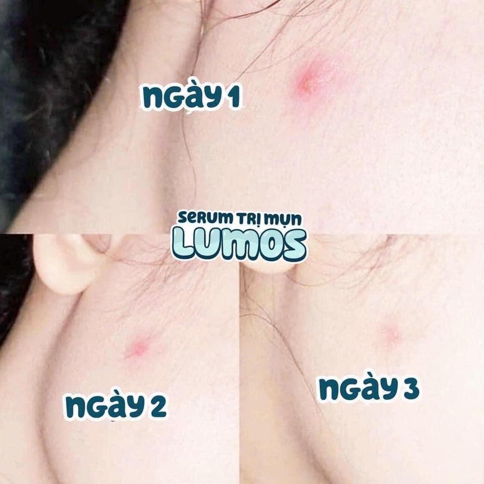 Serum mụn Lumos-duoc-ban-tai-Mỹ phẩm Linh Meo