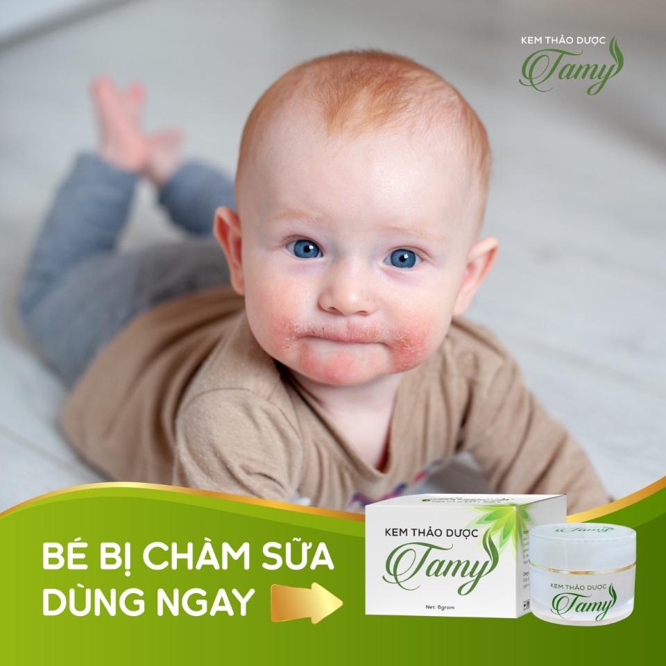 Kem Thảo Dược Tamy hỗ trợ giảm mẩn ngứa, ngăn ngừa rôm sẩy và giảm mụn-duoc-ban-tai-Nhà Thuốc Nguyễn Thúy.CHẤT LƯỢNG CAO          NIỀM TIN LỚN