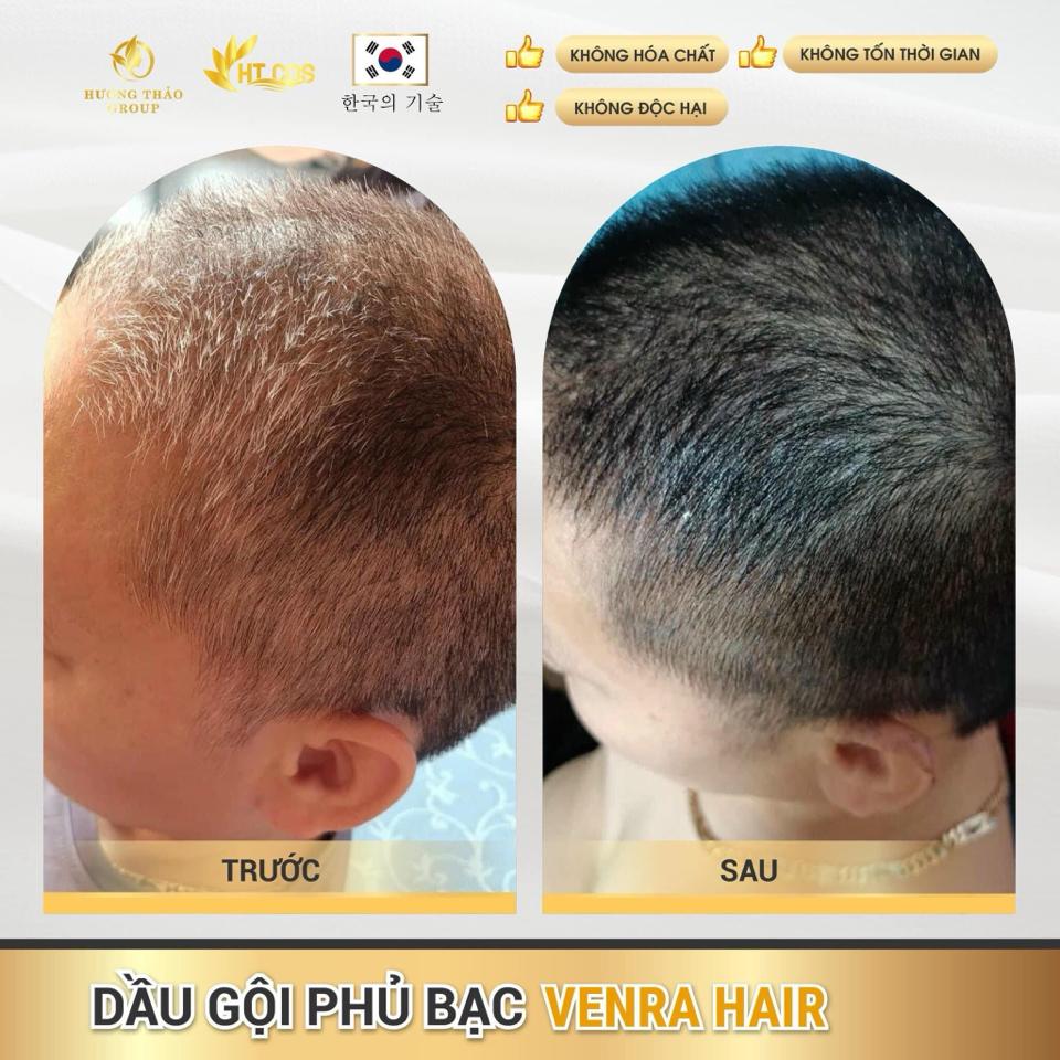 𝐃𝐚̂̀𝐮 𝐆𝐨̣̂𝐢 𝐏𝐡𝐮̉ 𝐁𝐚̣𝐜 𝐕𝐄𝐍𝐑𝐀 𝐇𝐀𝐈𝐑 – Đ𝐞𝐧 𝐭𝐨́𝐜 𝐜𝐡𝐢̉ 𝐬𝐚𝐮 𝟏 𝐥𝐚̂̀𝐧 𝐠𝐨̣̂𝐢 – 𝐀𝐧 𝐭𝐨𝐚̀𝐧 𝐤𝐡𝐨̂𝐧𝐠 𝐡𝐚̣𝐢 𝐭𝐨́𝐜-duoc-ban-tai-Hoa Nguyễn Natural Skin