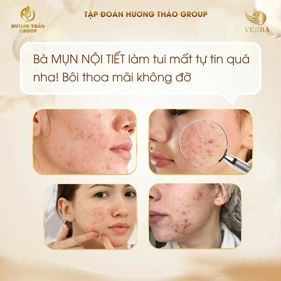 𝐒𝐞𝐫𝐮𝐦 𝐌𝐮̣𝐧 𝐊𝐢𝐧𝐠 𝐀𝐜𝐧𝐞 𝐕𝐄𝐍𝐑𝐀 – 𝐆𝐢𝐚̉𝐢 𝐩𝐡𝐚́𝐩 𝐤𝐡𝐚́𝐧𝐠 𝐯𝐢𝐞̂𝐦, 𝐬𝐞 𝐤𝐡𝐢́𝐭 𝐥𝐨̂̃ 𝐜𝐡𝐚̂𝐧 𝐥𝐨̂𝐧𝐠, 𝐡𝐨̂̃ 𝐭𝐫𝐨̛̣ 𝐦𝐨̛̀ 𝐭𝐡𝐚̂𝐦 𝐡𝐢𝐞̣̂𝐮 𝐪𝐮𝐚̉-duoc-ban-tai-Hoa Nguyễn Natural Skin