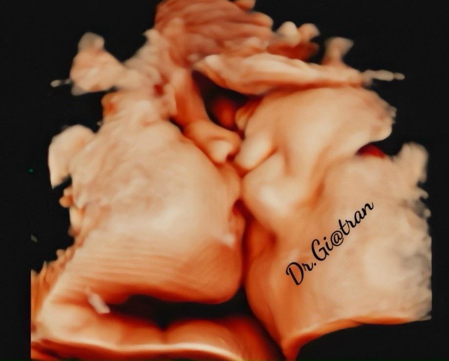 Siêu âm 4D 5D Hình thái -duoc-ban-tai-Phòng Khám Sản Phụ Khoa Bs Trần Phước Gia