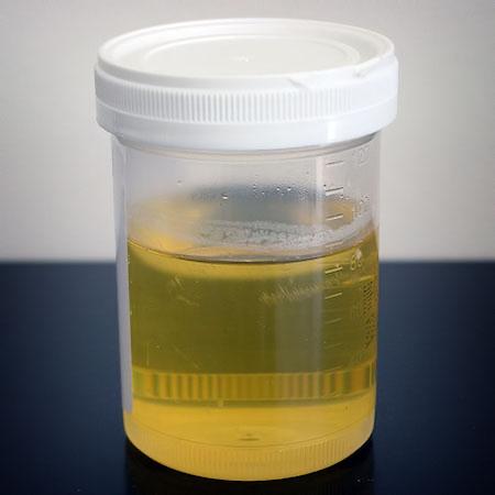 Xét nghiệm nước tiểu -duoc-ban-tai-Phòng Khám Sản Phụ Khoa Bs Trần Phước Gia