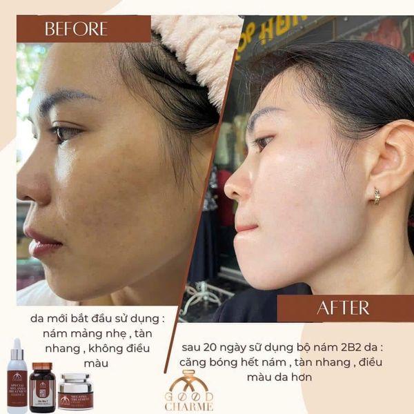 GC_Bộ xóa nám, tái sinh là da 2B2-duoc-ban-tai-Nguyệt Phương Shop