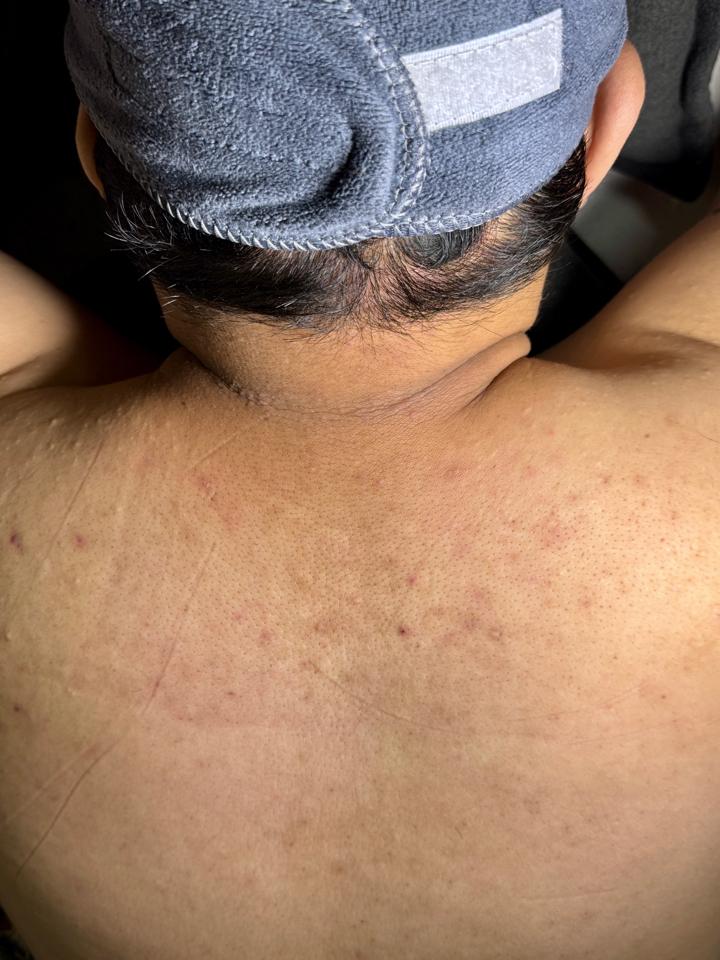 Peeling_ Khử thâm body-duoc-ban-tai-Bờ Tờ Tờ