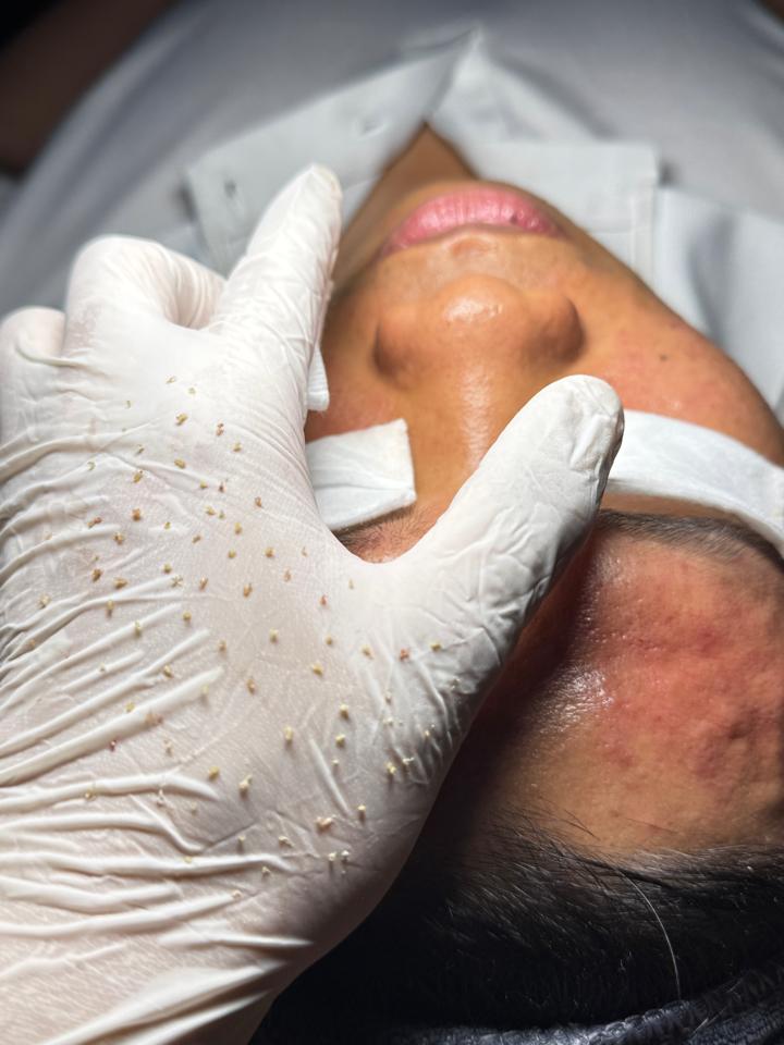 Xử lý Nhân Mụn cơ bản-duoc-ban-tai-Bờ Tờ Tờ