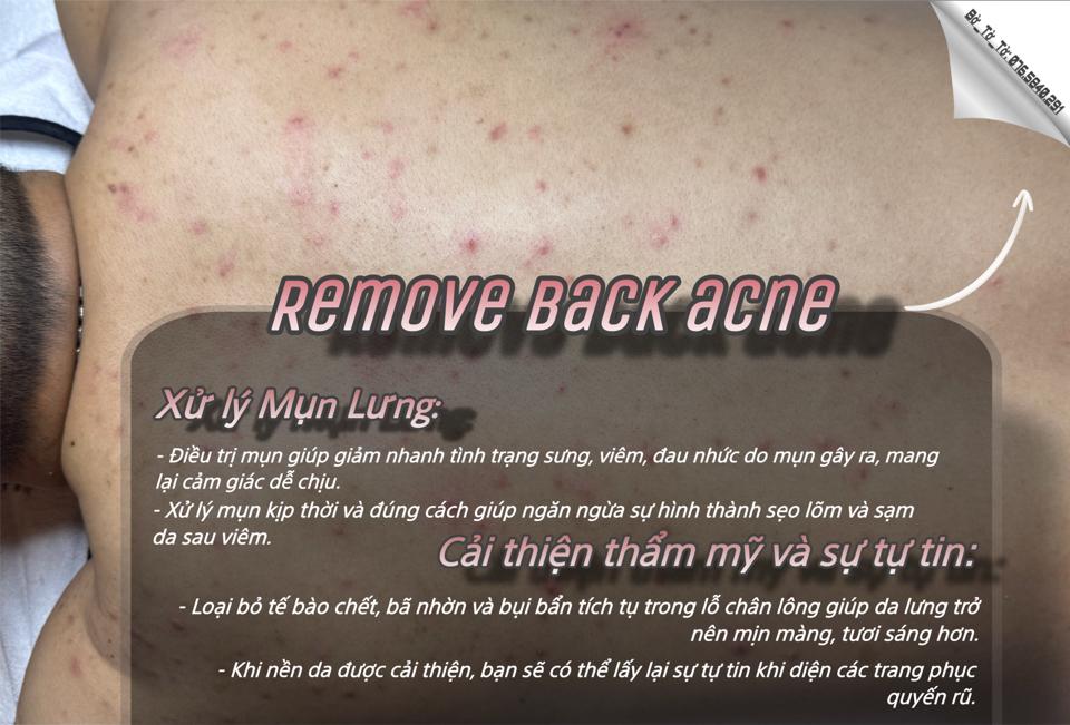 Xử lý Mụn Lưng-duoc-ban-tai-Bờ Tờ Tờ