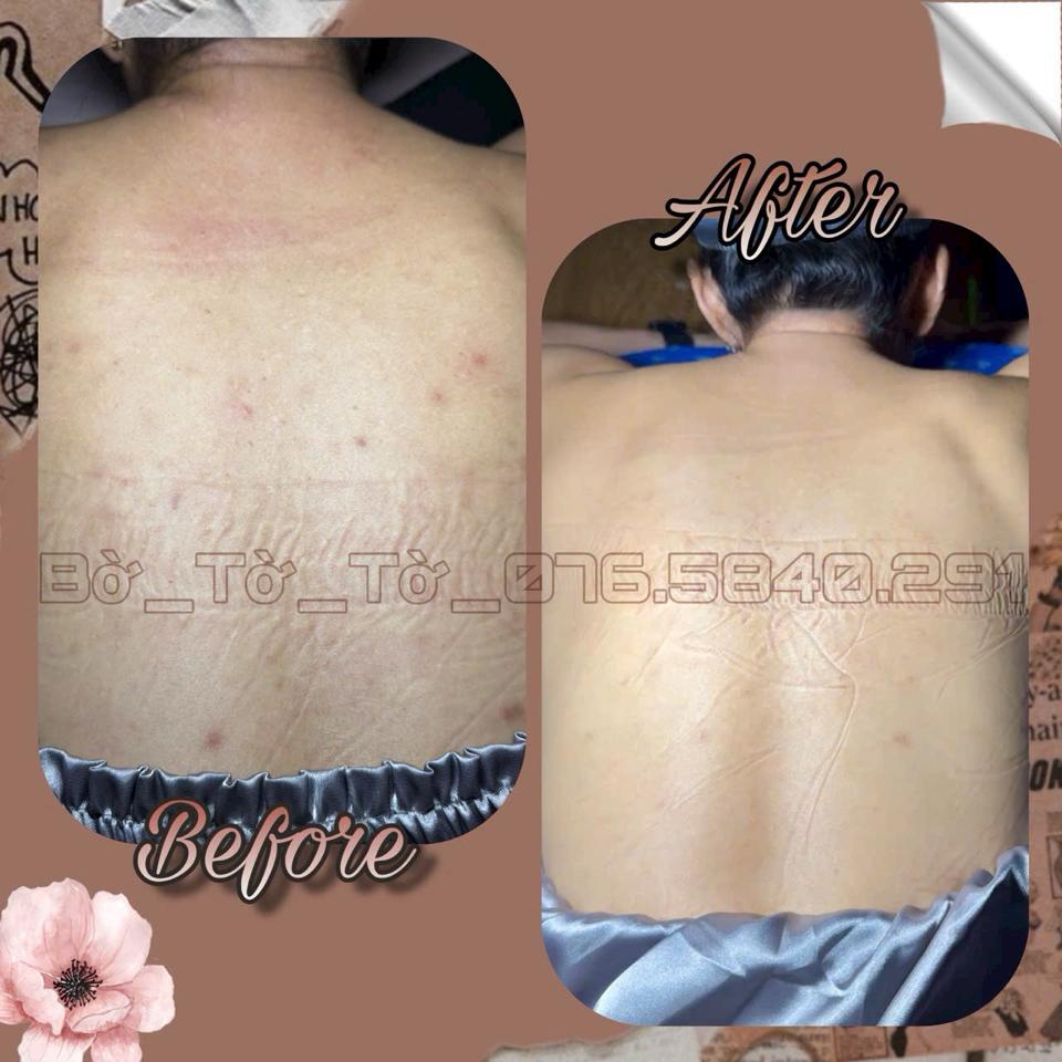Peeling_khử thâm body-duoc-ban-tai-Bờ Tờ Tờ