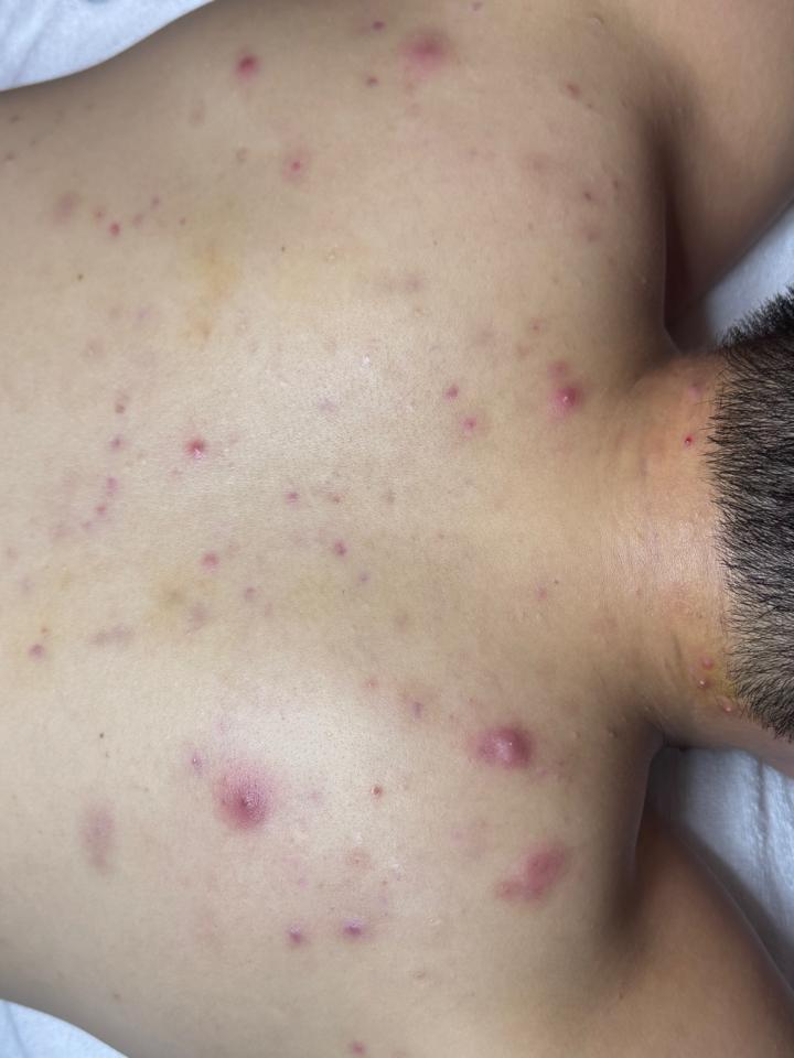 Xử lý Mụn Lưng-duoc-ban-tai-Bờ Tờ Tờ