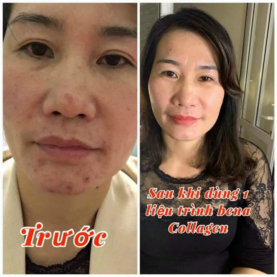 🍓#BENA_COLLAGEN SX THEO CÔNG NGHỆ HÀN QUỐC🍓
🍇BENA COLLAGEN  - SP uống siêu đẹp da cao cấp - hương trái cây 💖💯
👉HỘP 30 GÓI. 
♨Ngăn chặn sự hình thành các nếp nhăn, tăng tính đàn hồi & săn chắc của làn da, giúp da căng bóng.
♨Tăng cường độ ẩm & cải thiện sắc tố da, tóc.
♨Cung cấp chất chống oxy hóa bảo vệ da chống lại các tia cực tím có hại.
♨Bổ sung dinh dưỡng giúp tóc, móng dày & bóng hơn.
♨Phòng ngừa loãng xương & giảm đau khớp.
☑ BENA CLLAGEN được kết hợp các vitamin, các loại thảo dược, vì vậy chỉ cần 1 -2 gói #BENA_COLAGEN mỗi ngày thôi là làn da và sức khỏe của bạn sẽ được cải thiện rõ rệt.
Giá 497K 
Số lượng 1️⃣
☎️ 0797254043-duoc-ban-tai-PHƯƠNG LINH Shop