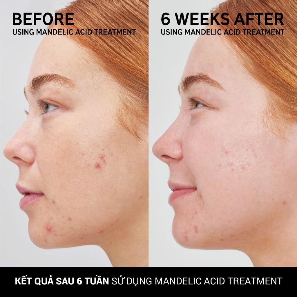 Serum giúp giảm thâm dành cho da mụn The Inkey List | Mandelic Acid Treament-duoc-ban-tai-Offload Spa